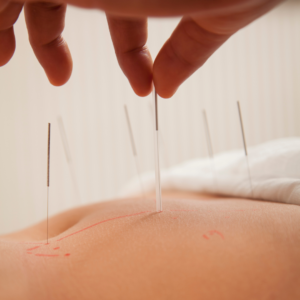 Tratamento para insônia: Agulha sendo colocada na barriga para den=monstrar o tratamento de acupuntura para insônia