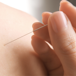 Acupuntura_8 tratamento para insônia com acupuntura